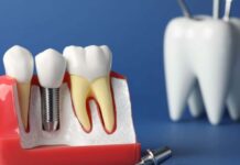 Implant dentar Bredent: Motivele pentru care este preferat în reabilitările rapide