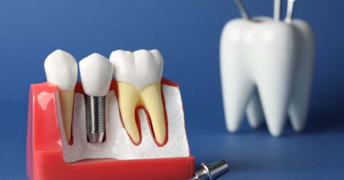 Implant dentar Bredent: Motivele pentru care este preferat în reabilitările rapide